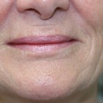 After Lip Injection