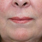 After Lip Injection