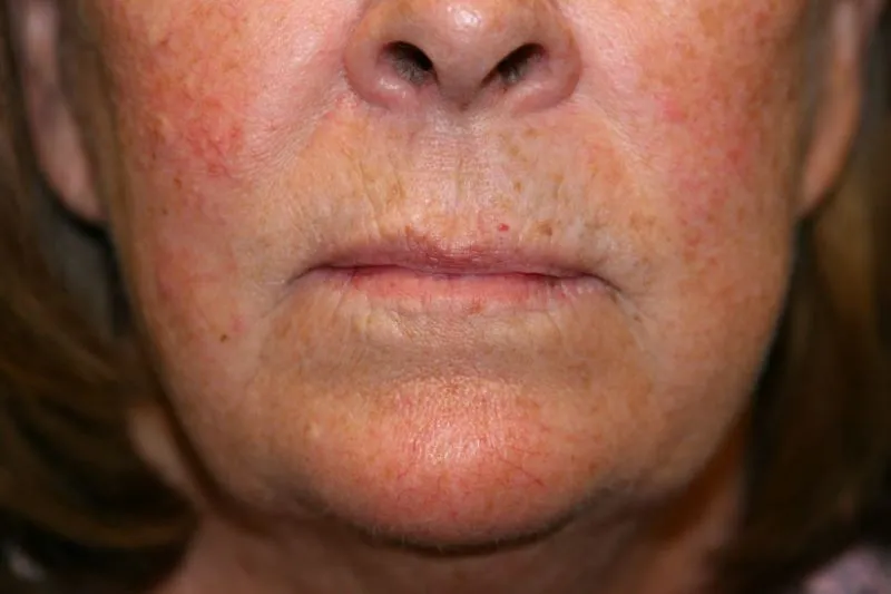 Before Lip Injection