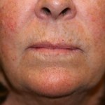Before Lip Injection