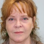 After 4 Lid Eyelid Lift