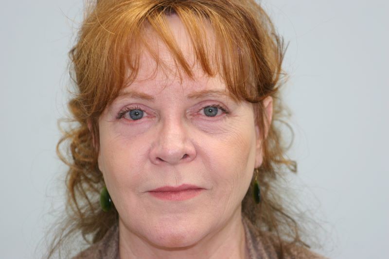 After 4 Lid Eyelid Lift