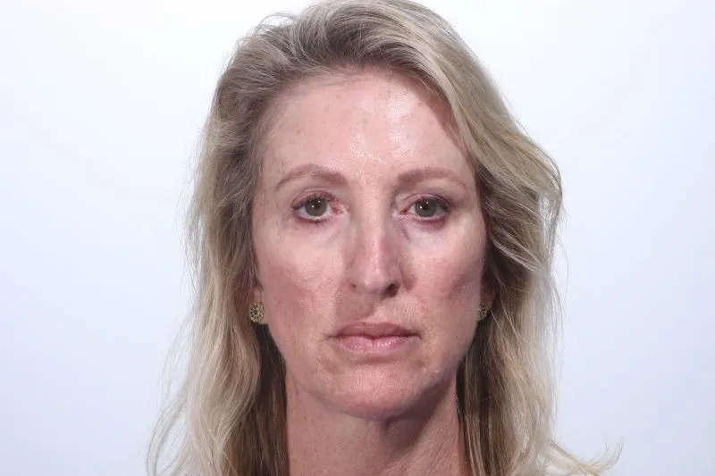 8 years after sculptra