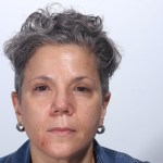 After 4 Lid Eyelid Lift