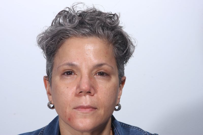 After 4 Lid Eyelid Lift