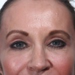 After 4 Lid Eyelid Lift