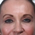 After 4 Lid Eyelid Lift