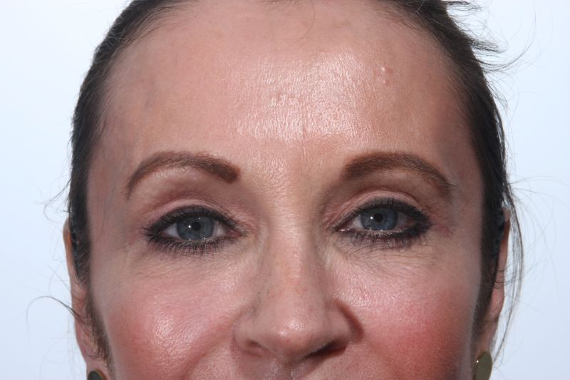 After 4 Lid Eyelid Lift