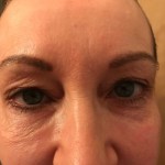 Before 4 Lid Eyelid Lift