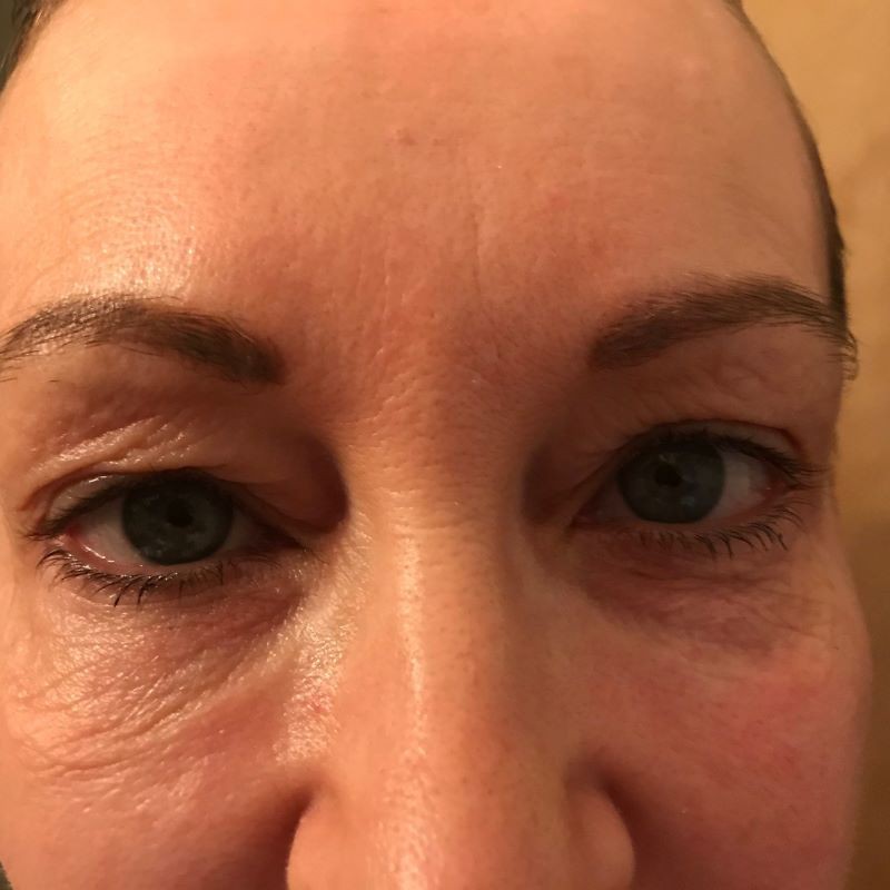 Before 4 Lid Eyelid Lift