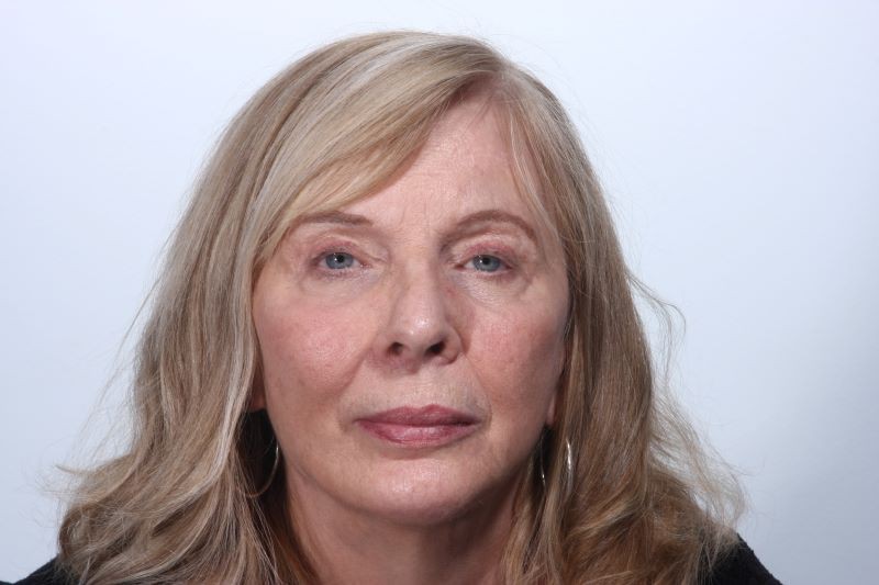 After Browlift