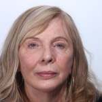 After Browlift
