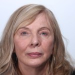 After Browlift