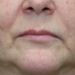 After Lip Injection