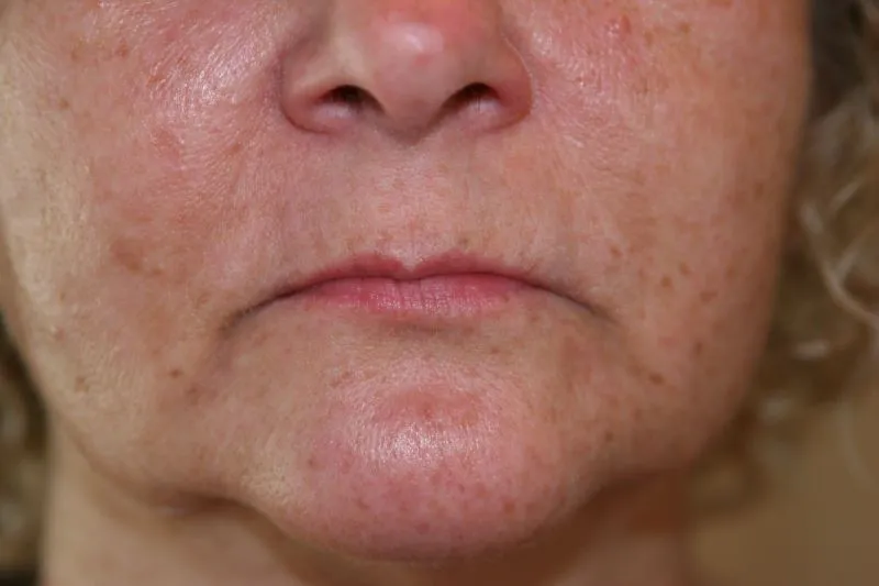 Before Lip Injection
