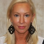 3 years after sculptra