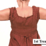 After first treatment Mesolipotherapy 
