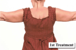 After first treatment Mesolipotherapy