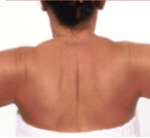 After Second Treatment Mesolipotherapy 