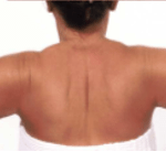 After Second Treatment Mesolipotherapy 