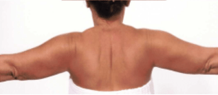 After Second Treatment Mesolipotherapy