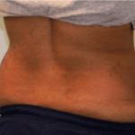 After Mesolipotherapy 
