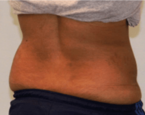 After Mesolipotherapy