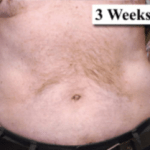 After Mesolipotherapy 