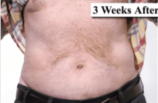 After Mesolipotherapy
