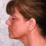 After Mesolipotherapy 