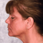 After Mesolipotherapy 