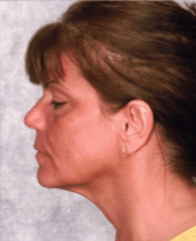 After Mesolipotherapy