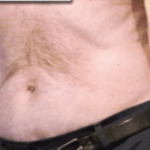 After Mesolipotherapy 