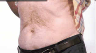 After Mesolipotherapy