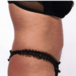 After Mesolipotherapy 