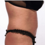 After Mesolipotherapy 