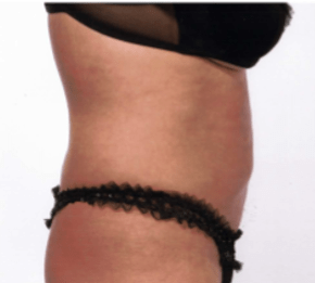 After Mesolipotherapy