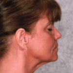 After Mesolipotherapy 