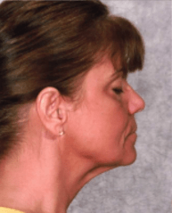 After Mesolipotherapy