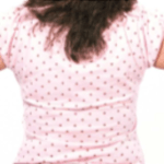 Before Mesolipotherapy 