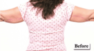 Before Mesolipotherapy