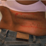 Before Mesolipotherapy 