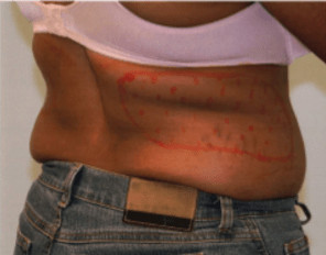 Before Mesolipotherapy