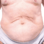 Before Mesolipotherapy 