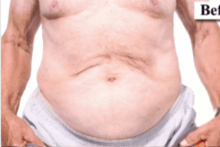 Before Mesolipotherapy