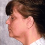 Before Mesolipotherapy 