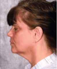 Before Mesolipotherapy