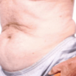 Before Mesolipotherapy 