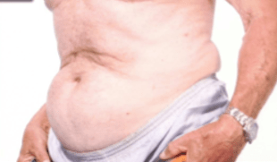 Before Mesolipotherapy