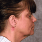 Before Mesolipotherapy 